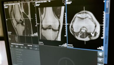 X-ray scans showing knee joints