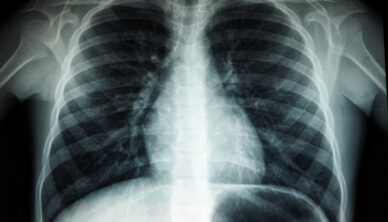 chest xray