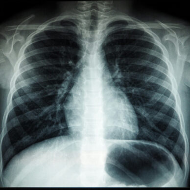 chest xray